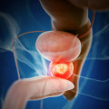 Understanding the Symptoms of Advanced Prostate Cancer