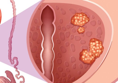 Understanding Stage 5 Prostate Cancer