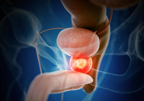 Understanding the Symptoms of Advanced Prostate Cancer