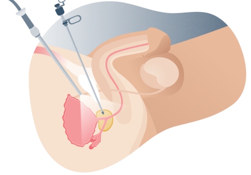 How Long Can You Leave Prostate Cancer Untreated? The Expert's Perspective