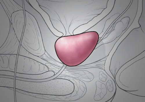 Understanding Stage 4 Prostate Cancer